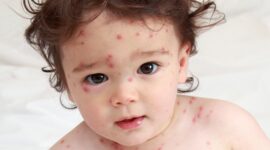 Baby with chicken pox rash