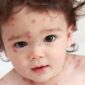 Baby with chicken pox rash
