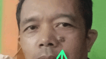 Testimoni Pengguna Nlevel1 Aktivasi 6 setelah Operasi Tahi Lalat Ganas